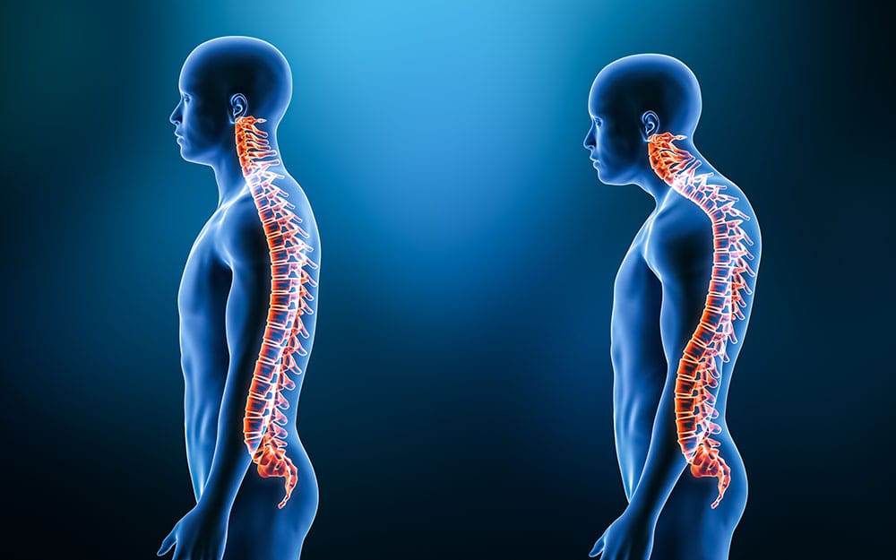 Comparison between normal curvature of the spine and kyphosis with male model from lateral view 3D rendering illustration. Human anatomy, spinal disorders or deformity, backbone pathology, medical concepts.