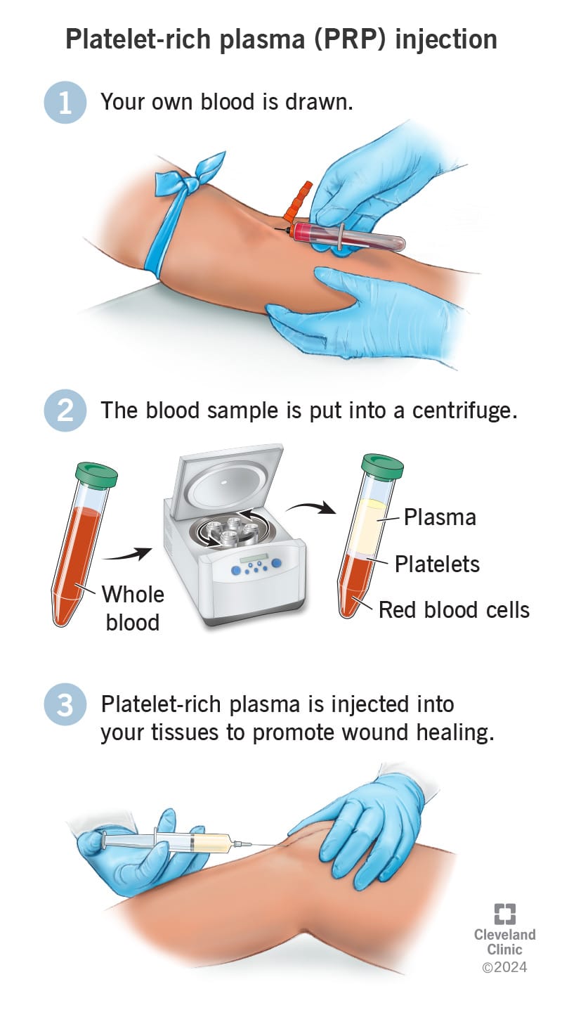PRP Injection - Cleveland Clinic Photo Credit